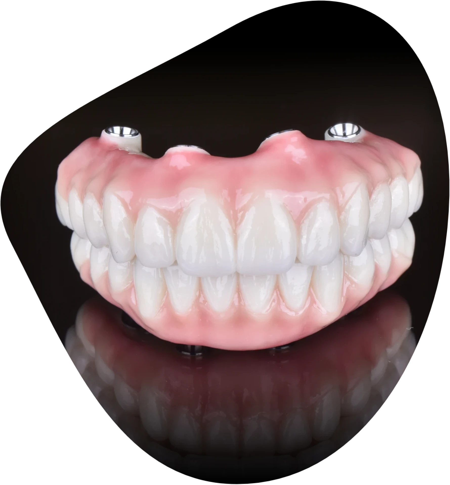 Photo of an all on 4 dental implants bridge