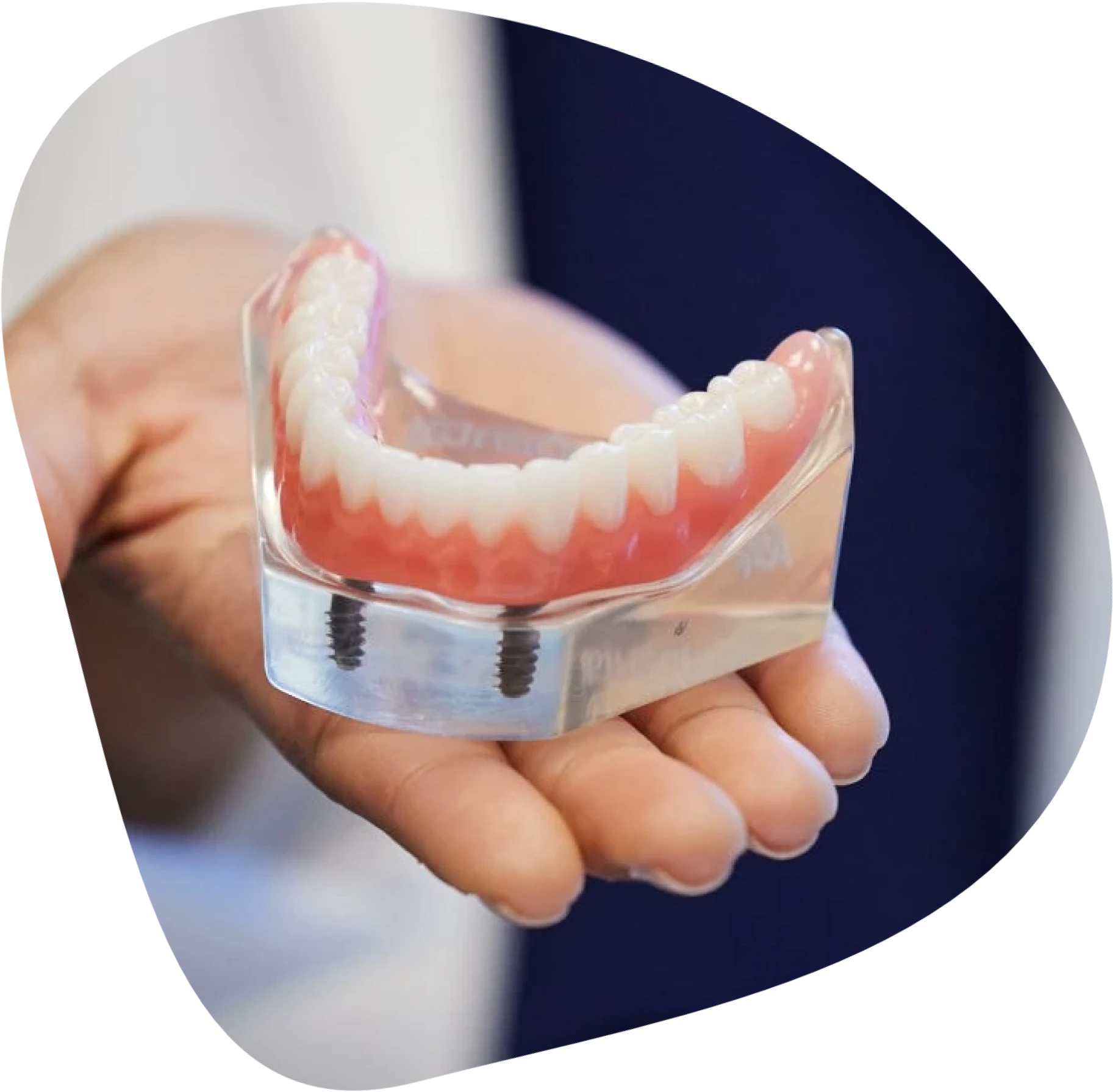 Photo of a doctor holding a model of lower snap in dentures.