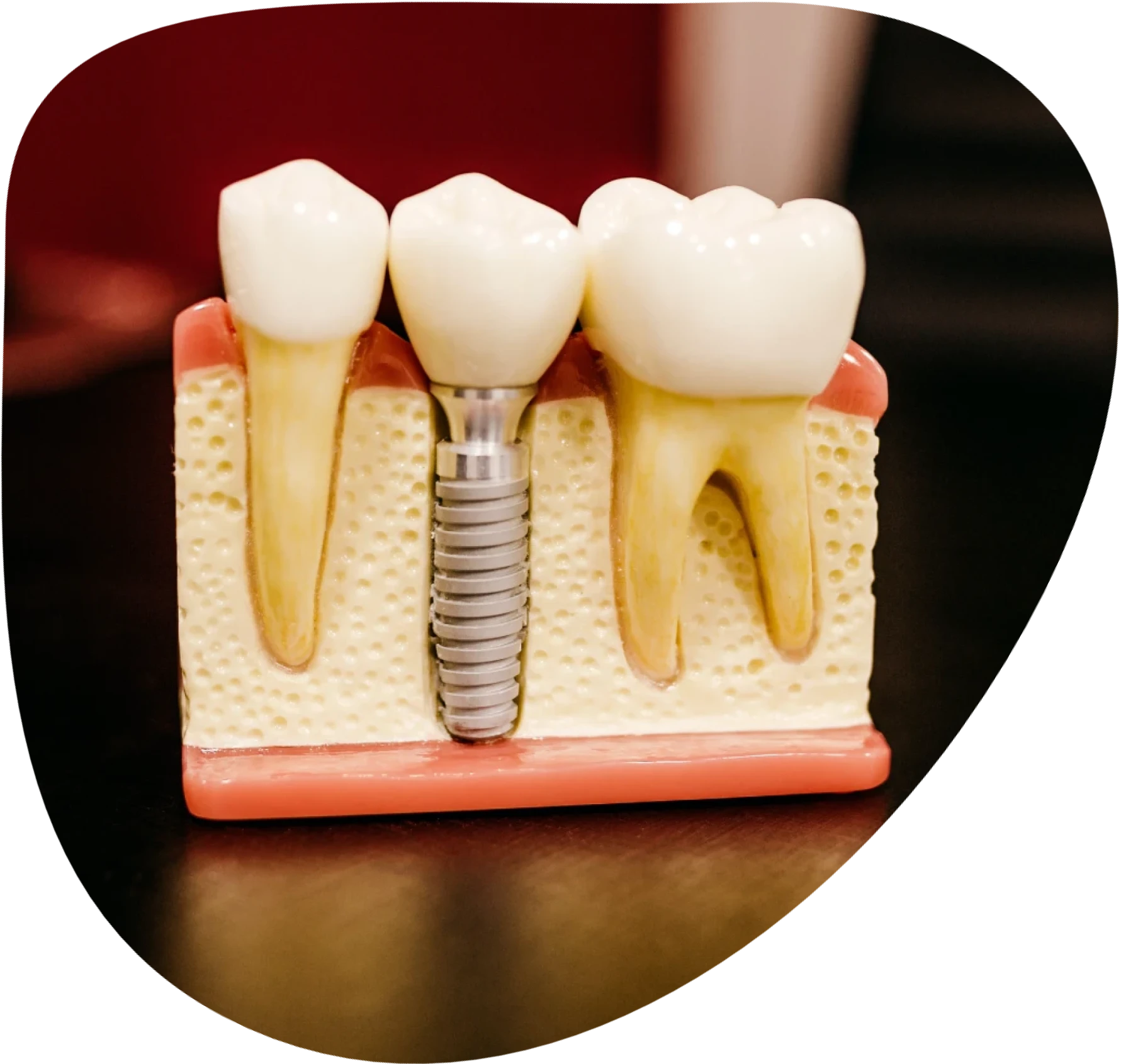 Photo of a single tooth dental implant model on a desk.